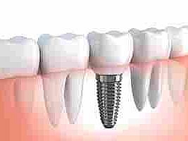 Păstrăm dinții sau punem implanturi ?